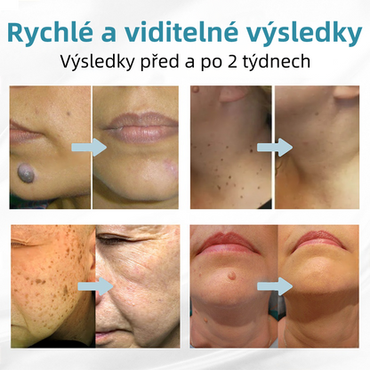KIDSNEED® Neinvazivní laserové pero na odstranění bradavic a znamének - silně Recommended by the Czech Dermatovenerological Society (ČDS)🔥