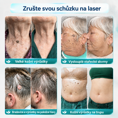 𝐄𝐦𝐞𝐦𝐚𝐱® 2v1 mikrojádrová a hydrokoloidní náplast na odstranění znamének (bez bolesti, bez jizev)🍁