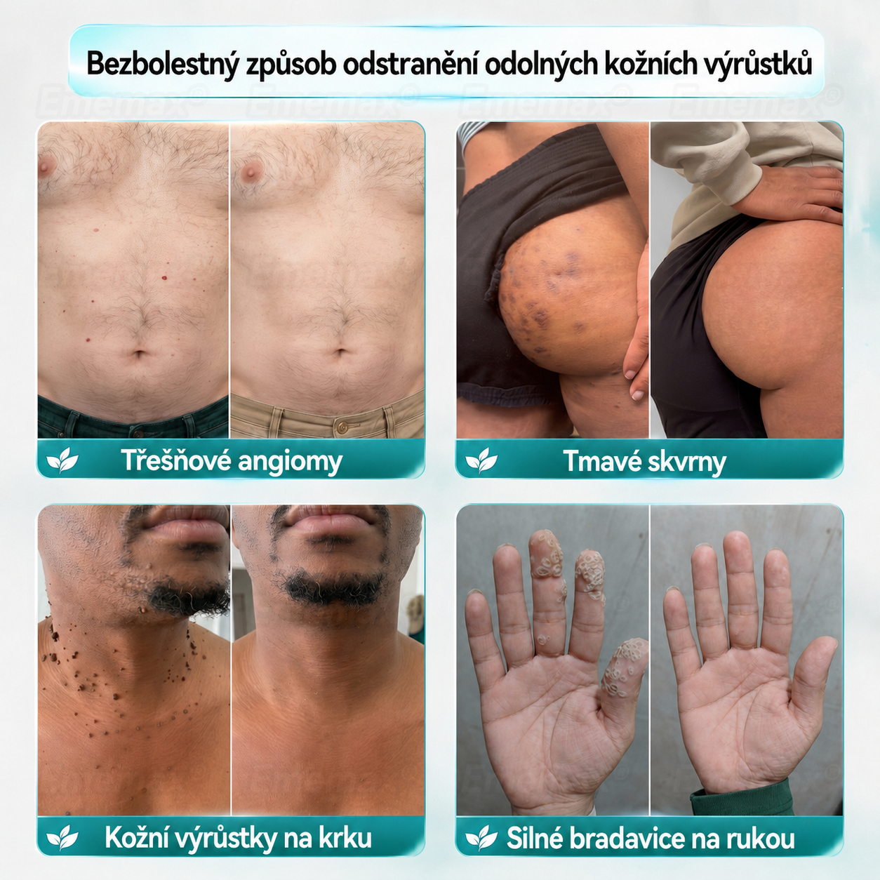 𝐄𝐦𝐞𝐦𝐚𝐱® 2v1 mikrojádrová a hydrokoloidní náplast na odstranění znamének (bez bolesti, bez jizev)🍁