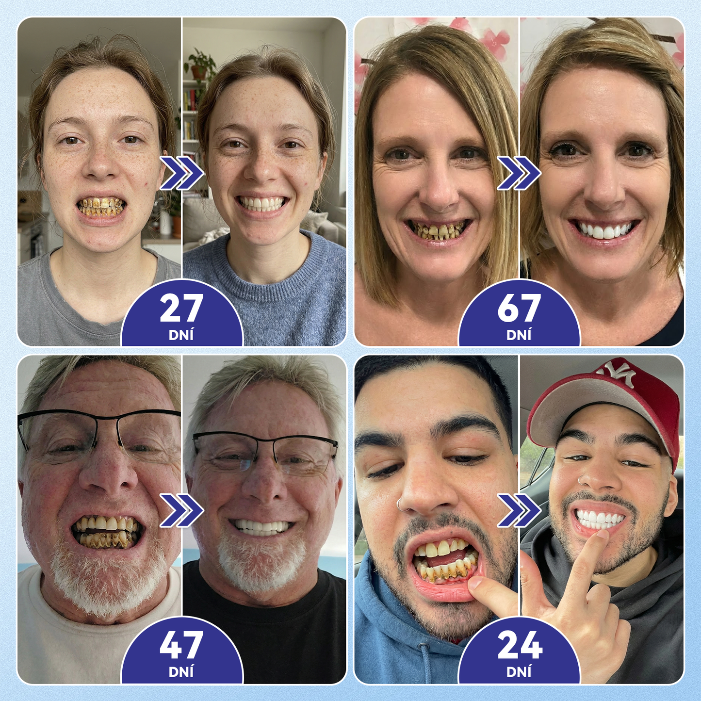 𝑮𝒍𝒊𝒎𝒎𝒆𝒓𝒍𝒚®🦷  𝑻𝒊𝒅𝒆𝒈𝒍𝒖𝒔𝒊𝒃 𝑴𝒊𝒄𝒓𝒐𝒏𝒆𝒆𝒅𝒍𝒆 𝑷𝒂𝒕𝒄𝒉 𝒏𝒂 𝒐𝒑𝒓𝒂𝒗𝒖 𝒛𝒖𝒃ů 𝒂 𝒅á𝒔𝒏í | Pokročilé náplasti pro aktivaci kmenových buněk zubů 👩‍⚕️ (Obnova zubní skloviny a dentinu • Posílení dásní • Odstranění zubního kamene a zápachu • Zastavení citlivosti zubů)💎