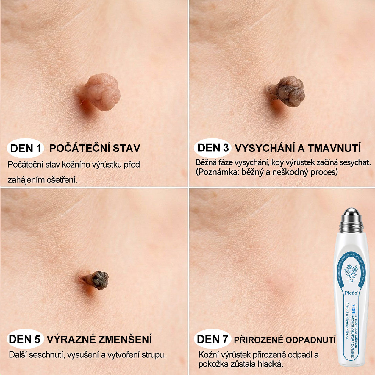 Oficiální značkový obchod |👩‍⚕️𝐏𝐢𝐜𝑑𝑜® 𝟩𝖽𝖾𝗻𝗻í 𝘰𝘥𝘴𝘵𝗋𝖺ň𝗈𝗏𝖺č 𝒔𝒌𝒗𝒓𝙣 𝙖 𝙥𝙞𝙜𝙢𝙚𝙣𝙩𝘰𝘷ý𝘤𝘩 𝘴𝘬𝖛𝖗𝖓 (Bezbolestný rollerball bez jizev)🎉