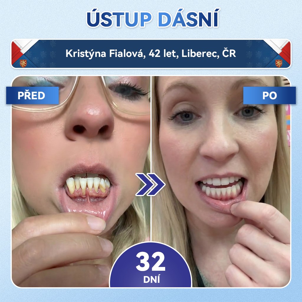 𝑮𝒍𝒊𝒎𝒎𝒆𝒓𝒍𝒚®🦷  𝑻𝒊𝒅𝒆𝒈𝒍𝒖𝒔𝒊𝒃 𝑴𝒊𝒄𝒓𝒐𝒏𝒆𝒆𝒅𝒍𝒆 𝑷𝒂𝒕𝒄𝒉 𝒏𝒂 𝒐𝒑𝒓𝒂𝒗𝒖 𝒛𝒖𝒃ů 𝒂 𝒅á𝒔𝒏í | Pokročilé náplasti pro aktivaci kmenových buněk zubů 👩‍⚕️ (Obnova zubní skloviny a dentinu • Posílení dásní • Odstranění zubního kamene a zápachu • Zastavení citlivosti zubů)💎